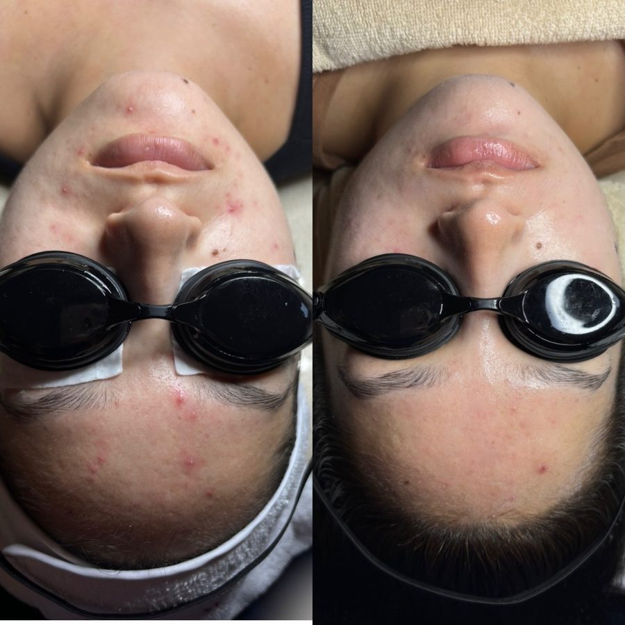 Acne · 3 Weeks