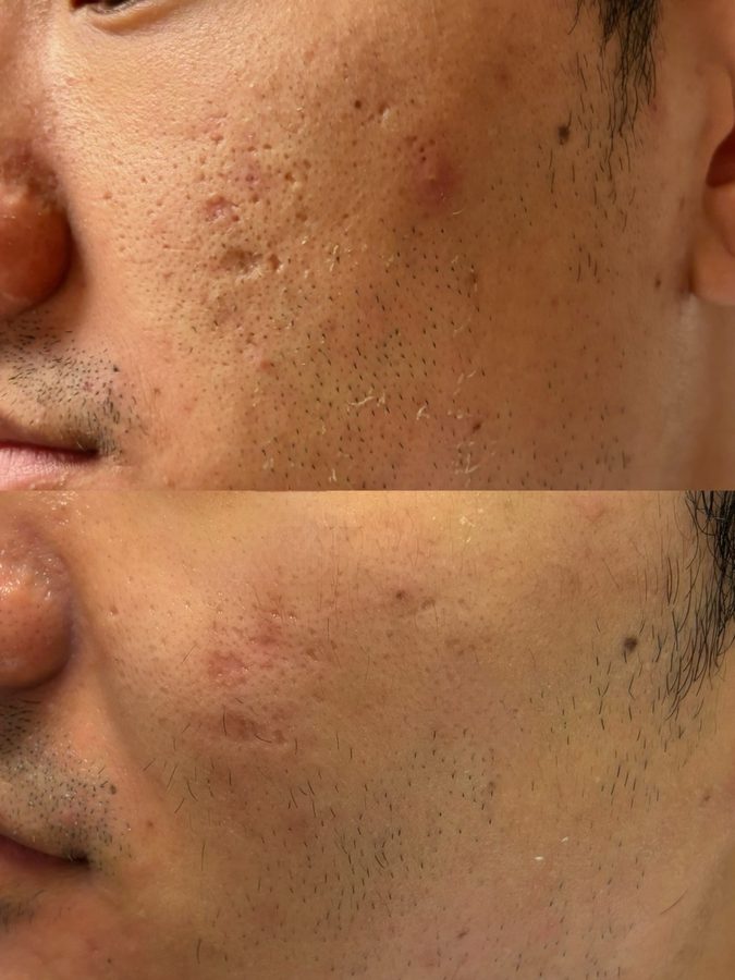 Acne · 5 Weeks