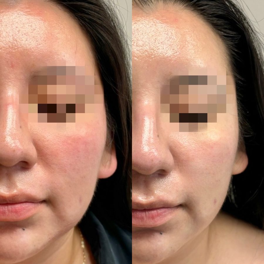 Immune Booster + Ultrasound Lifting
